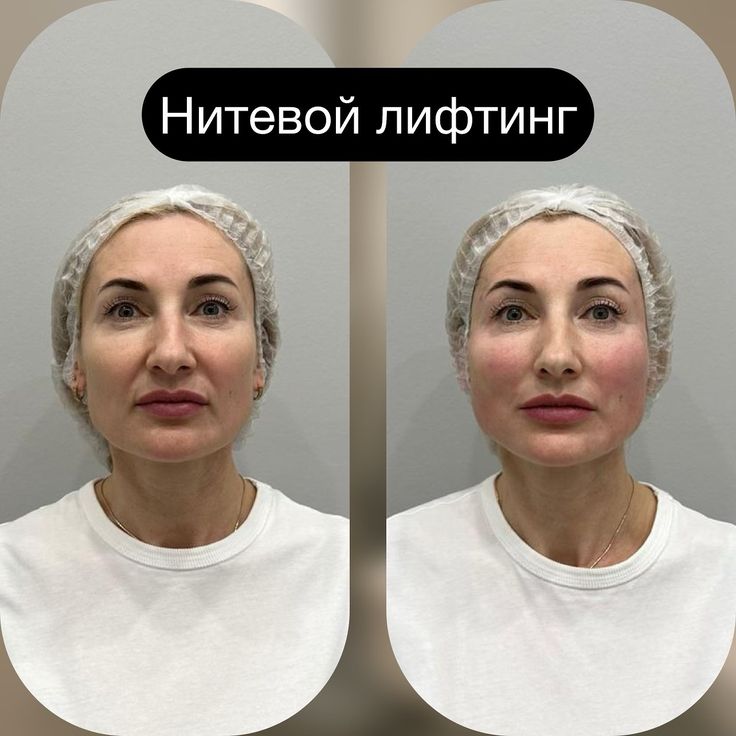ПОДТЯЖКА ЛИЦА Нити  полимолочные всё  60 шт.