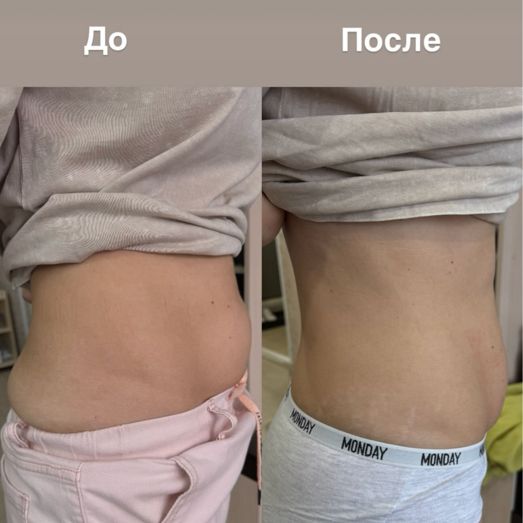 Микроигольчатый RF-лифтинг подтяжка кожи живота после родов и операций
