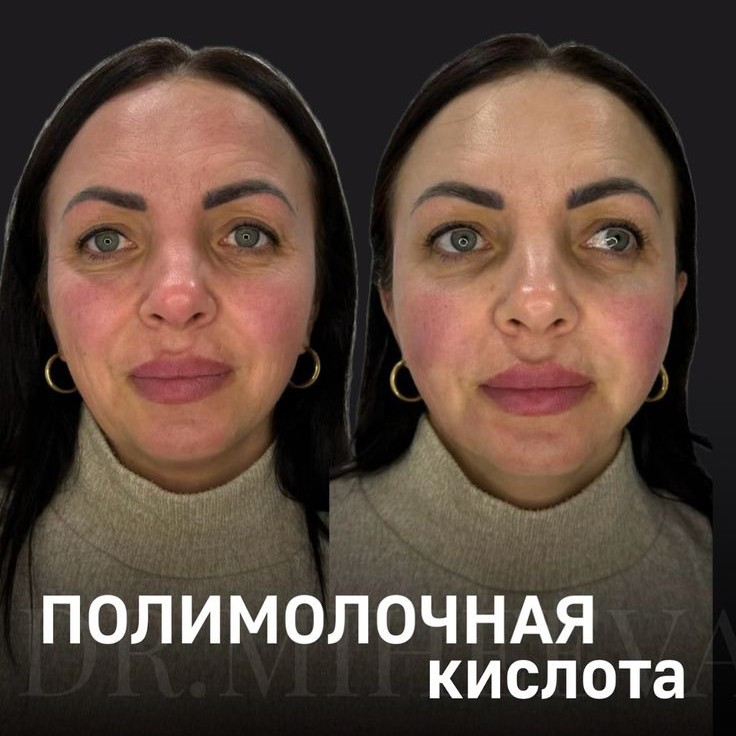 СКУЛЬПТРА полимолочная кислота  ( иньекционная подтяжка лица или тела  ( SKULPTRA )10 мл. канюля