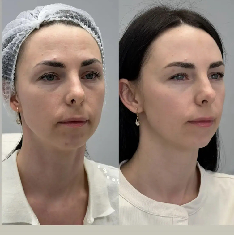 Ботулинотерапия