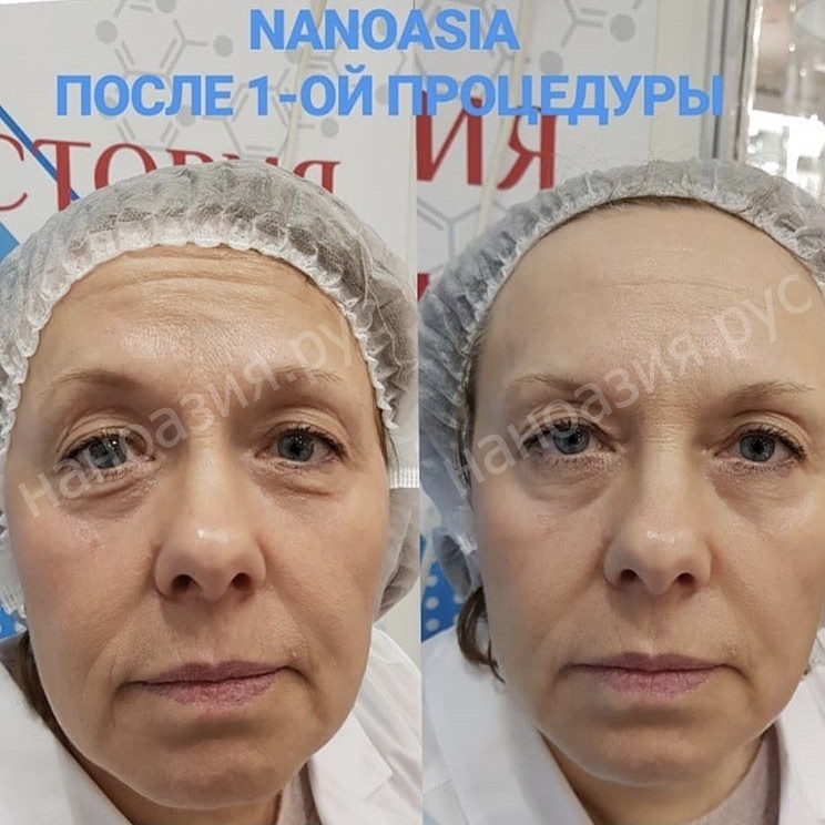 Безиньекционная  биоревитализация НАНОАЗИЯ