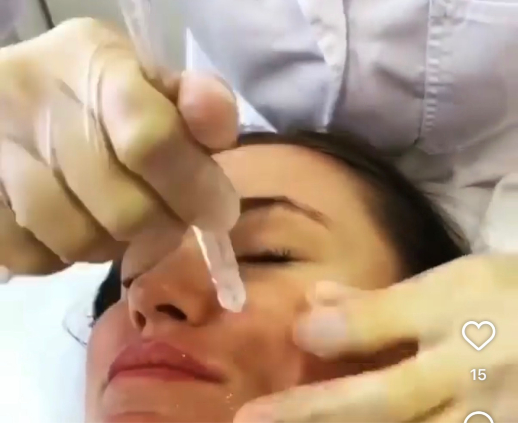«Безинъекционная мезотерапия JETPEEL»