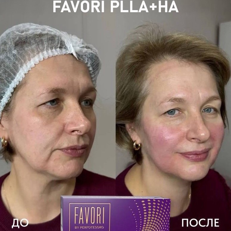 Восстановление контура полимолочная кислота plla favori Фавори