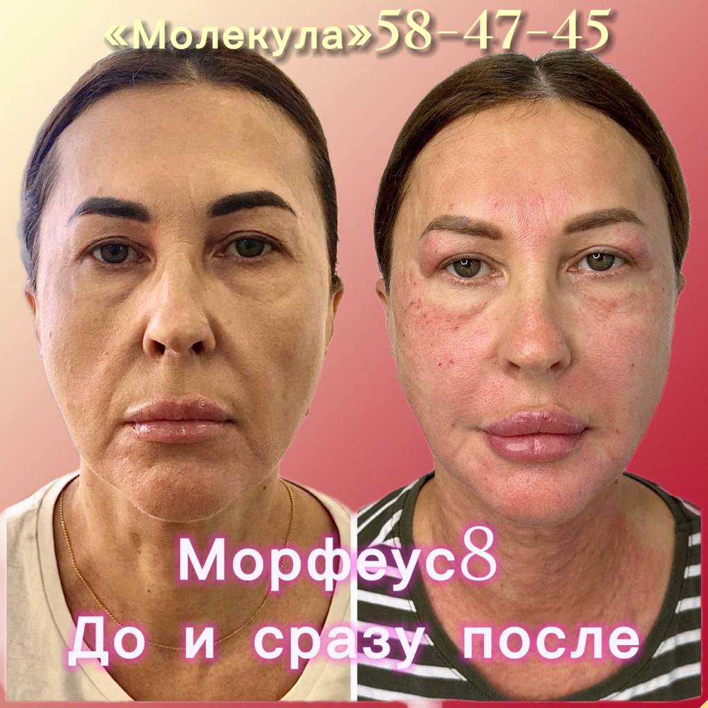 💙Морфеус8      ✔️лицо+ второй подбородок «STRONG”