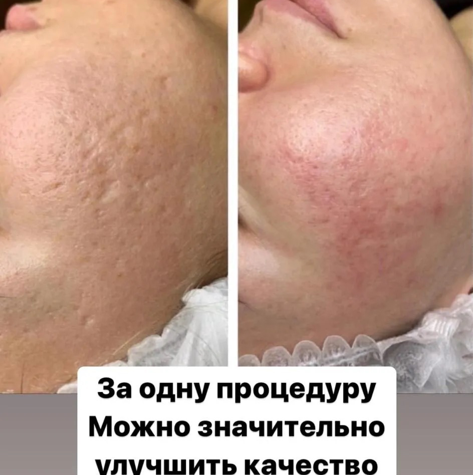 💙Морфеус8 ✔️Шлифовка пост акне ➡️протокол обучения Корея