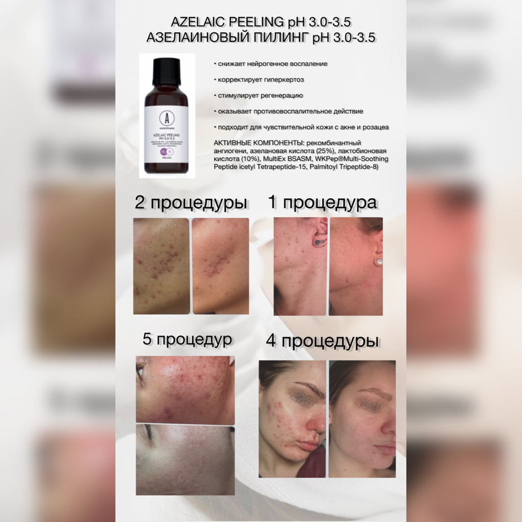 Азелаиновый пилинг + УЗ чистка лица