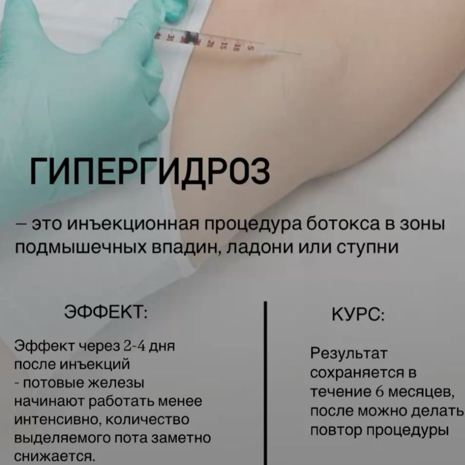 АКЦИЯ 13 000 вместо 15 000 Гипергидроз ( лечение потливости)