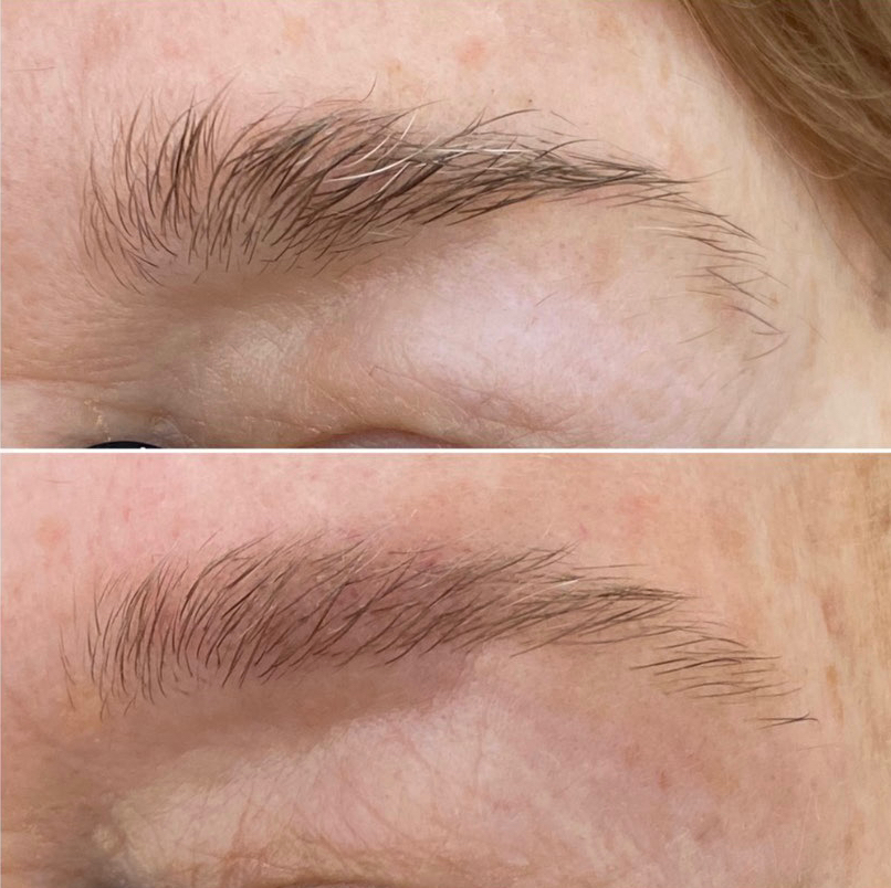 Restructuration des sourcils