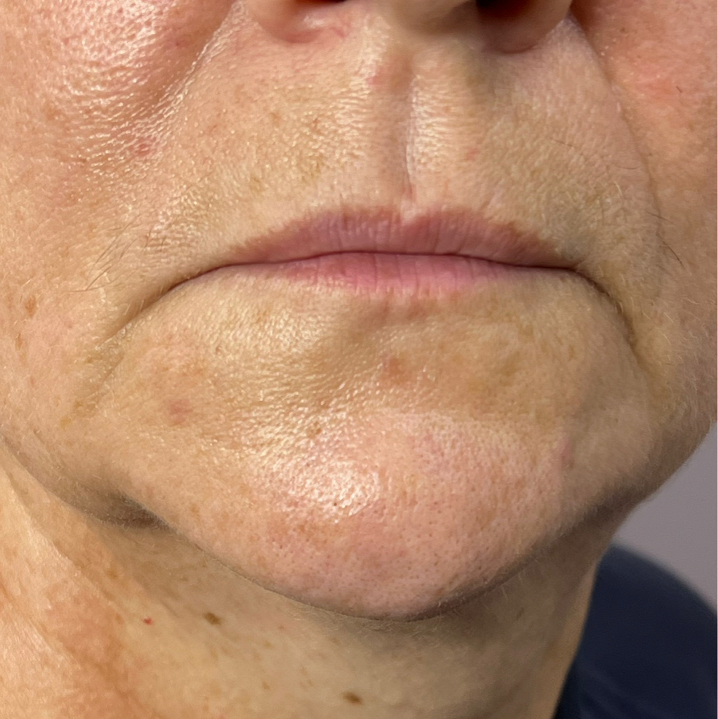Депиляция 1 зона лица