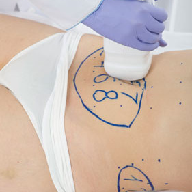 Liposonix Бедро (8 квадратов)