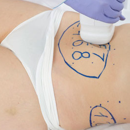 Liposonix Бока (6 квадратов )