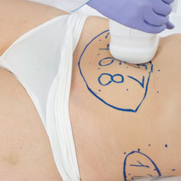 Liposonix Живот (8 квадратов )
