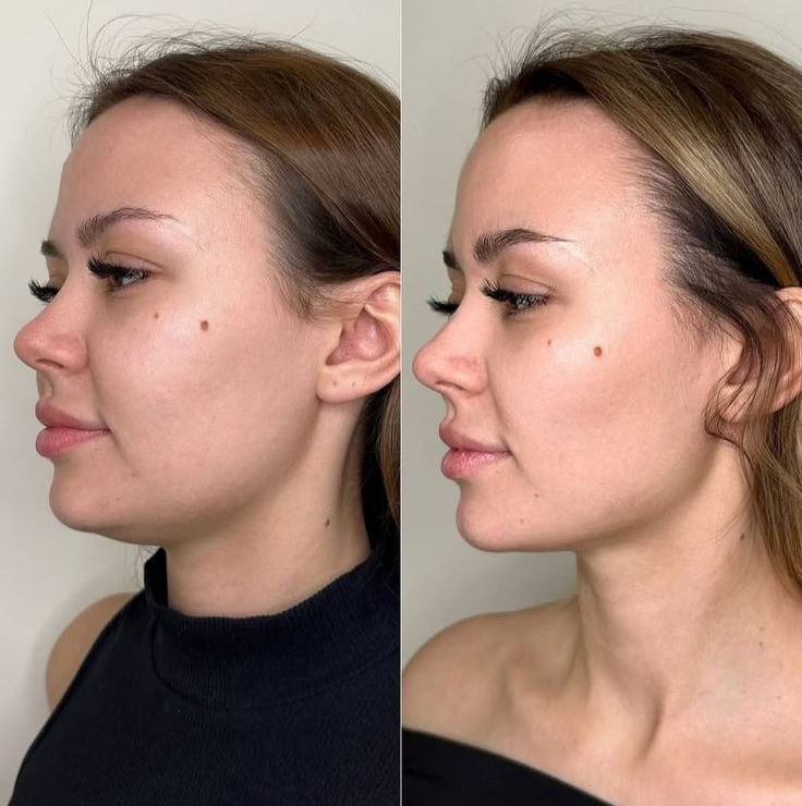 Липолитики для лица (пептидные) JADE FACE