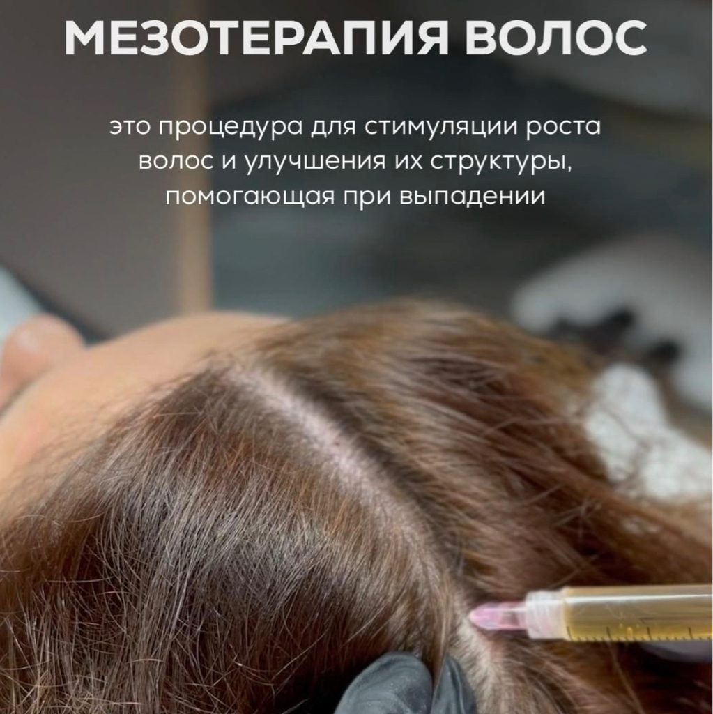 Мезотерапия от выпадения волос