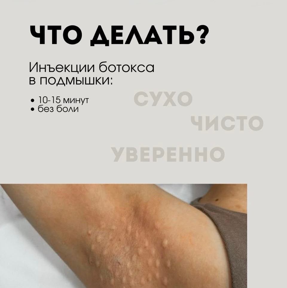 Лечение гипергидроза