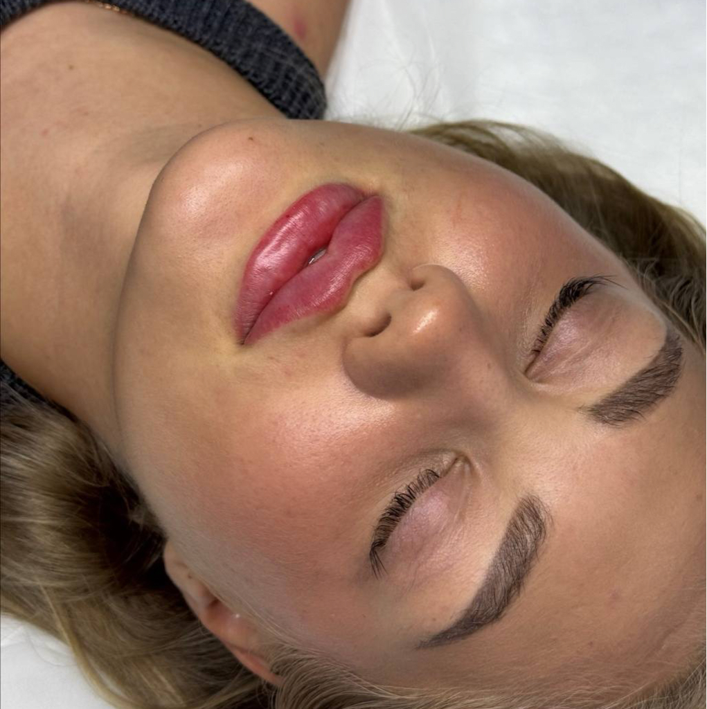 Juvederm ultra smile (05,5)