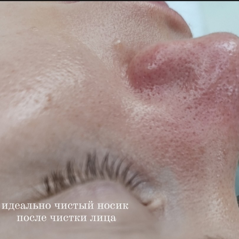 Чистка лица
