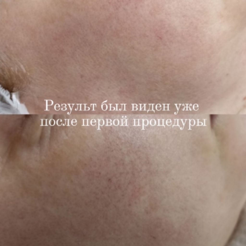 Антикупероз