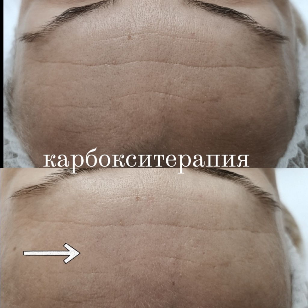 Неинвазивная  карбокситерапия