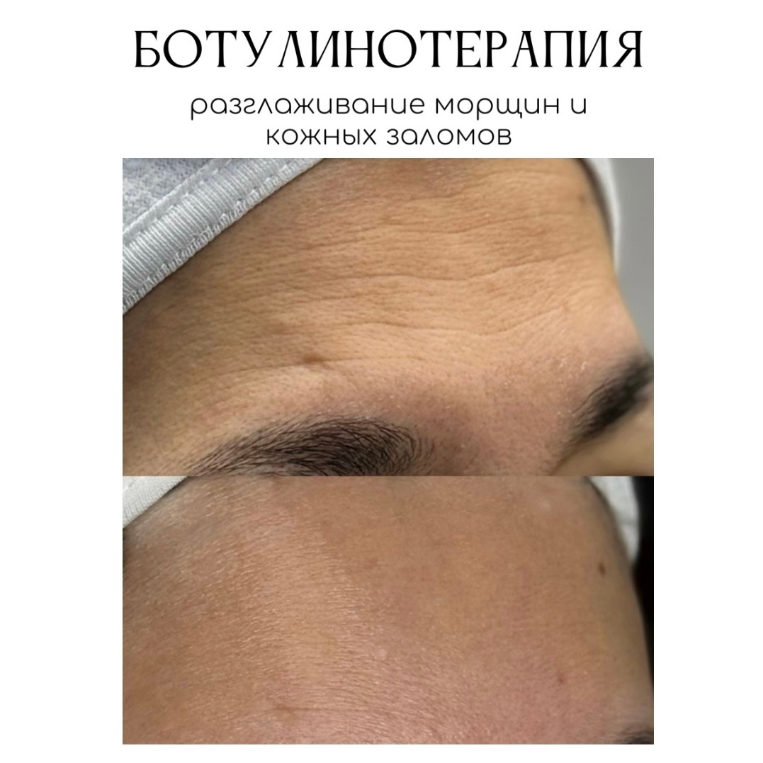 Миотокс
