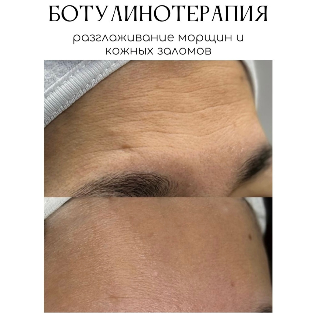 Ксеомин