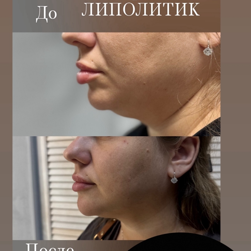 Липолитик