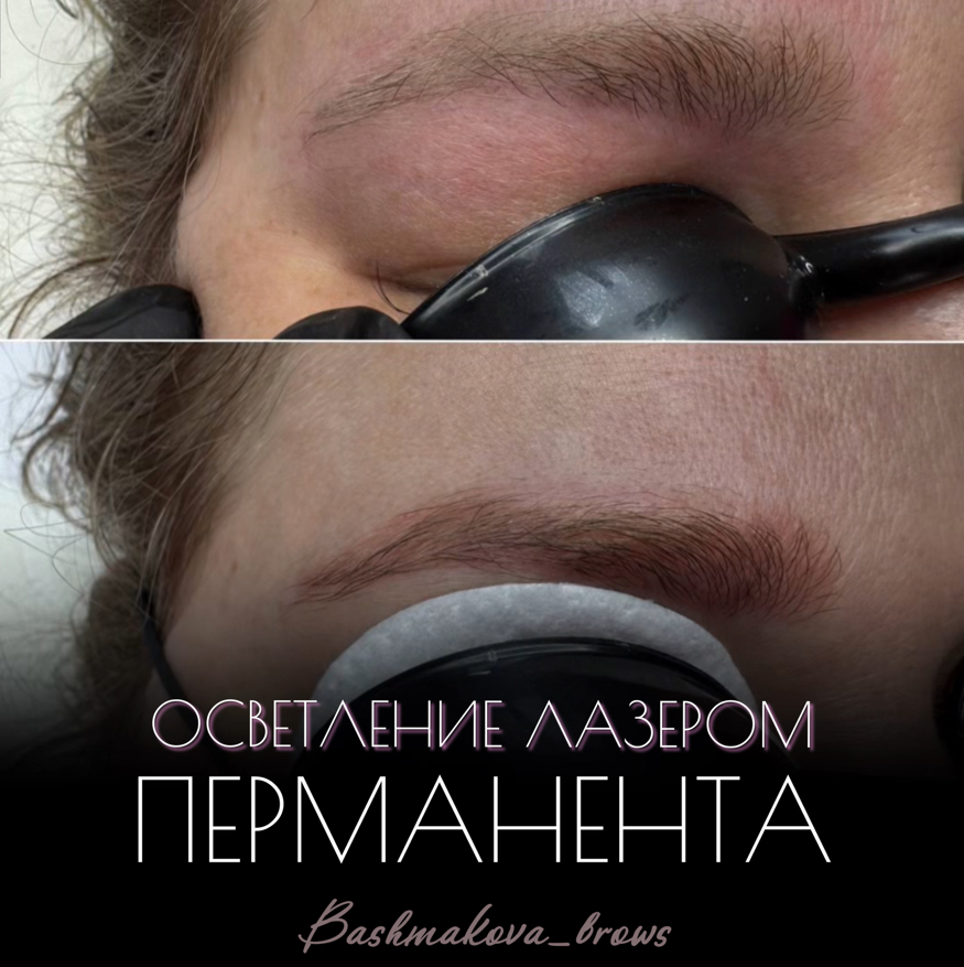 Удаление/ осветление старого татуажа лазером