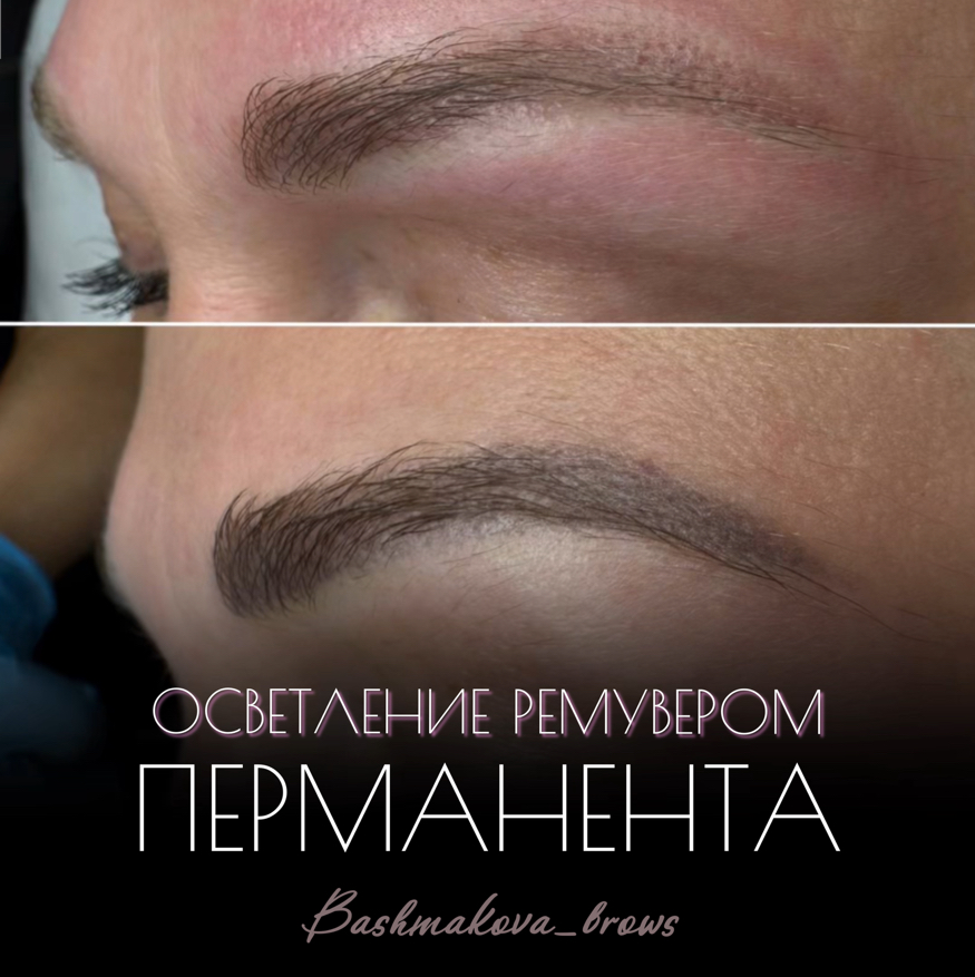 Удаление некачественного татуажа ремувером