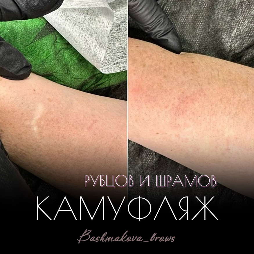 Камуфляж рубцов/шрамов