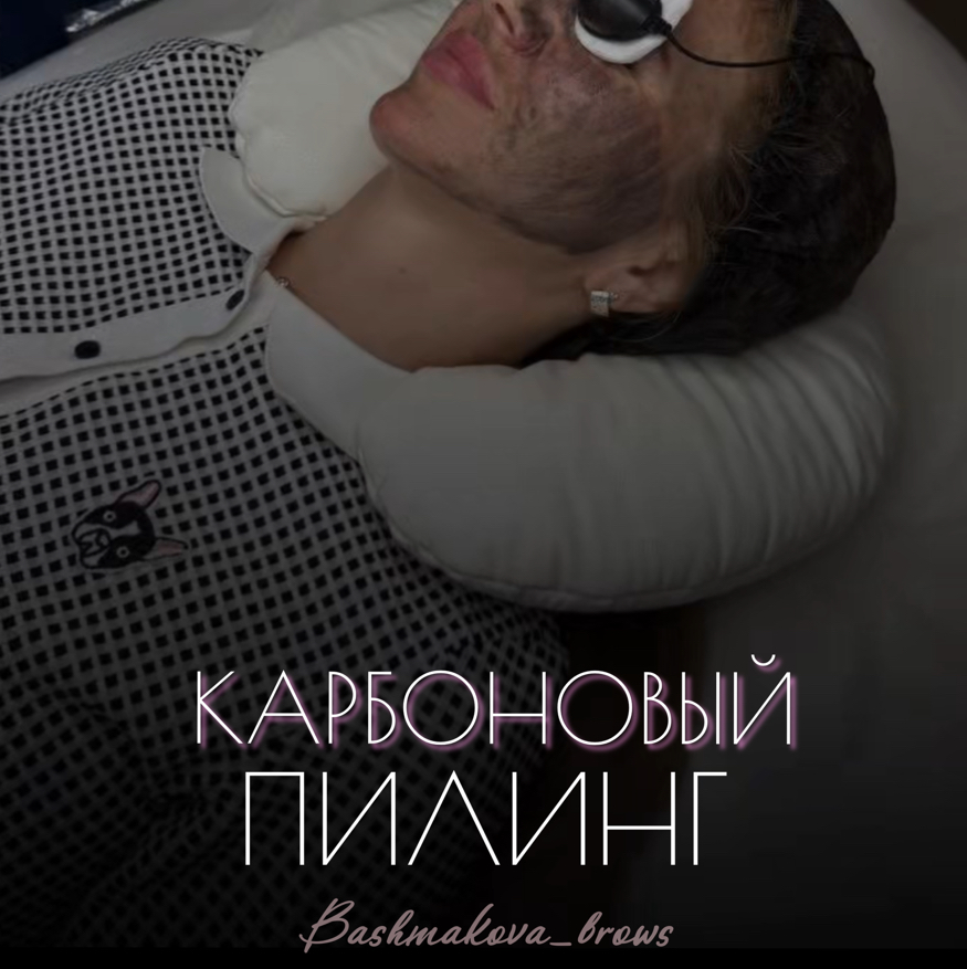 Карбоновый пилинг