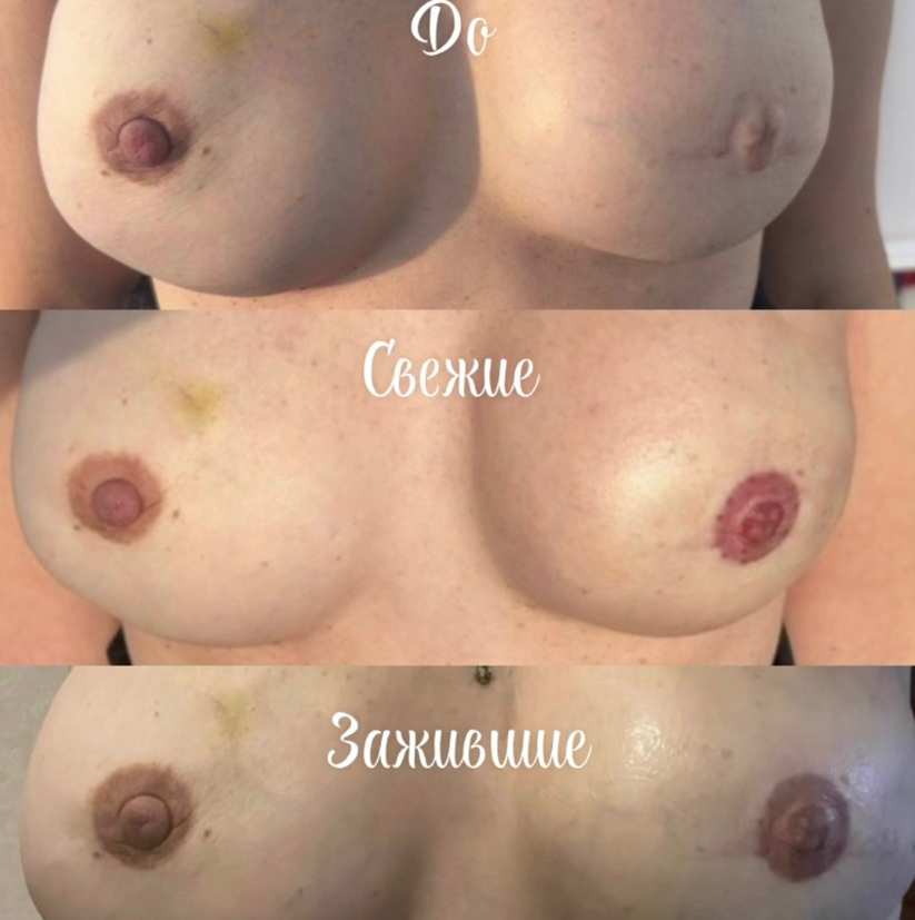 Коррекция камуфляжа ареолы через 1-3мес